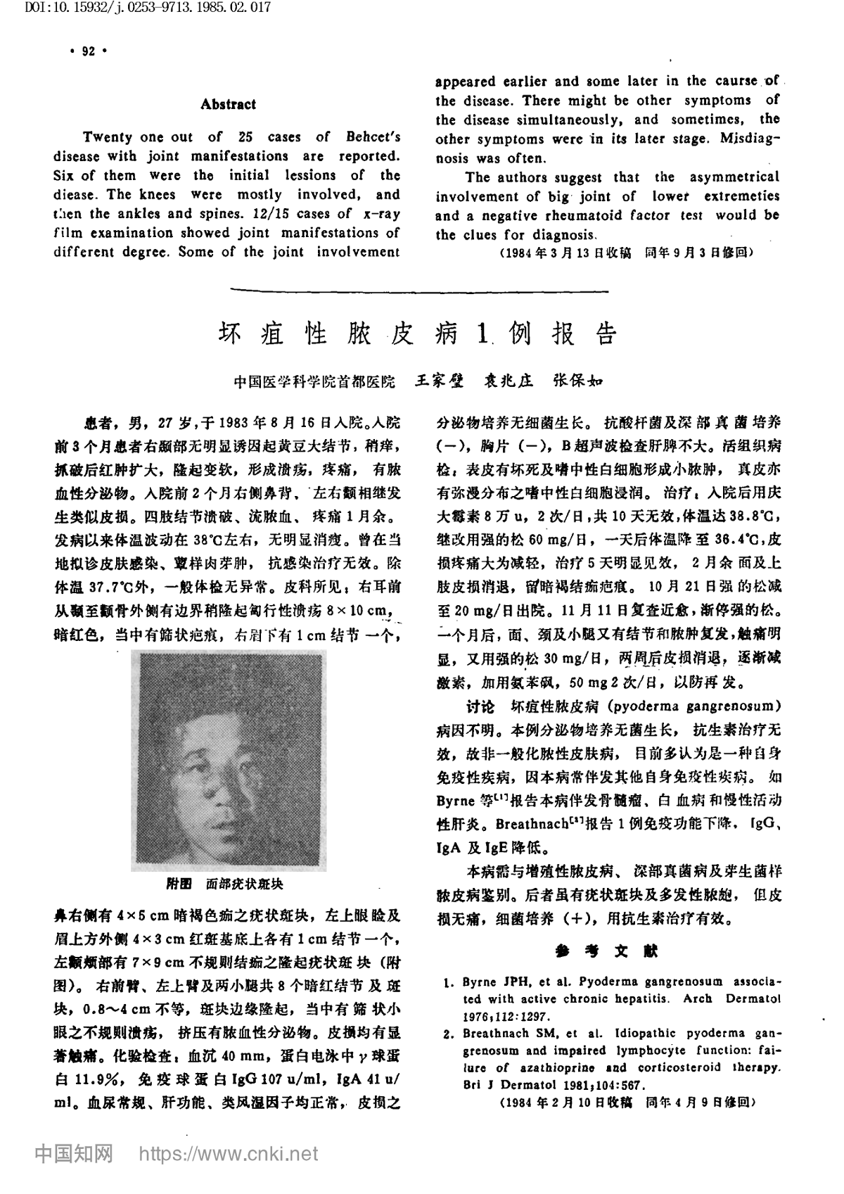 坏疽性脓皮病例报告