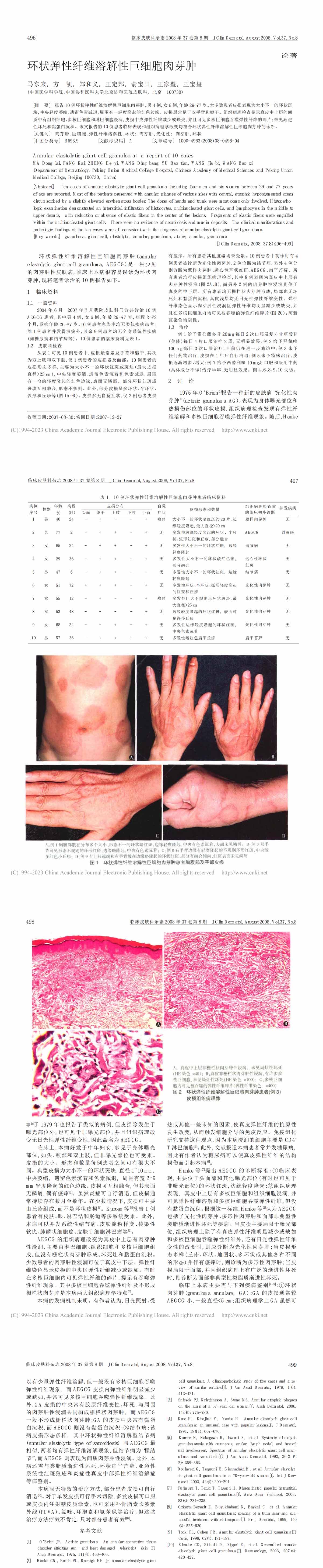 环状弹性纤维溶解性巨细胞肉芽肿