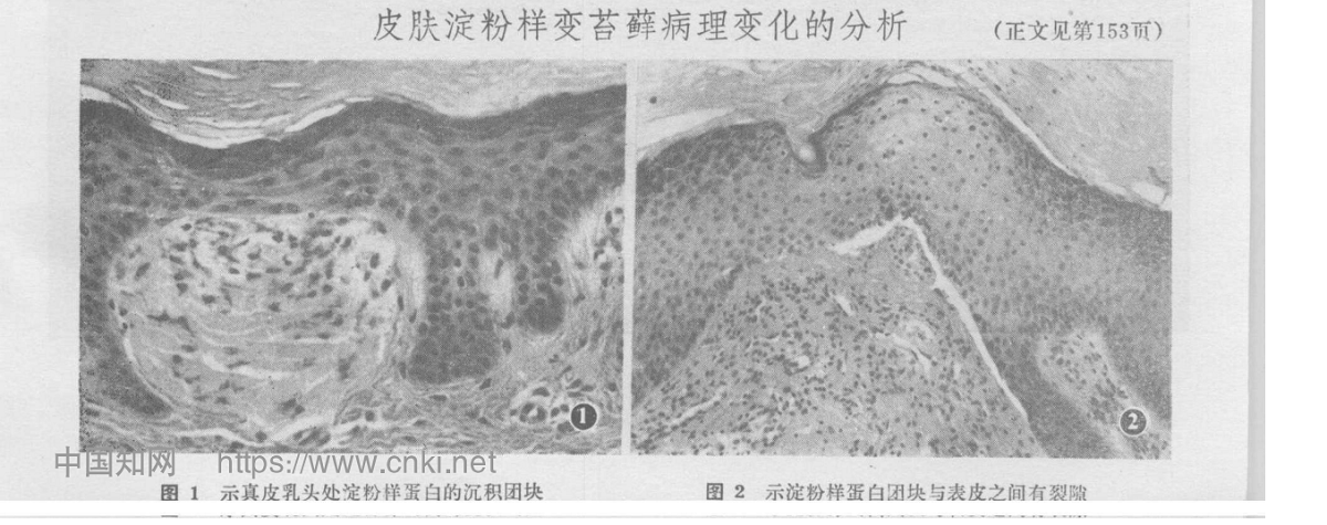 皮肤淀粉样变苔藓病理变化的分析