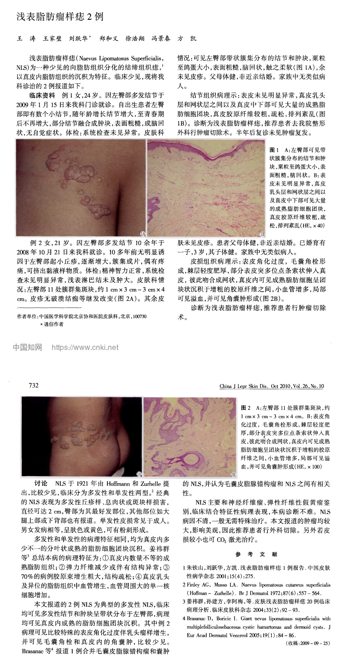 浅表脂肪瘤样痣2例