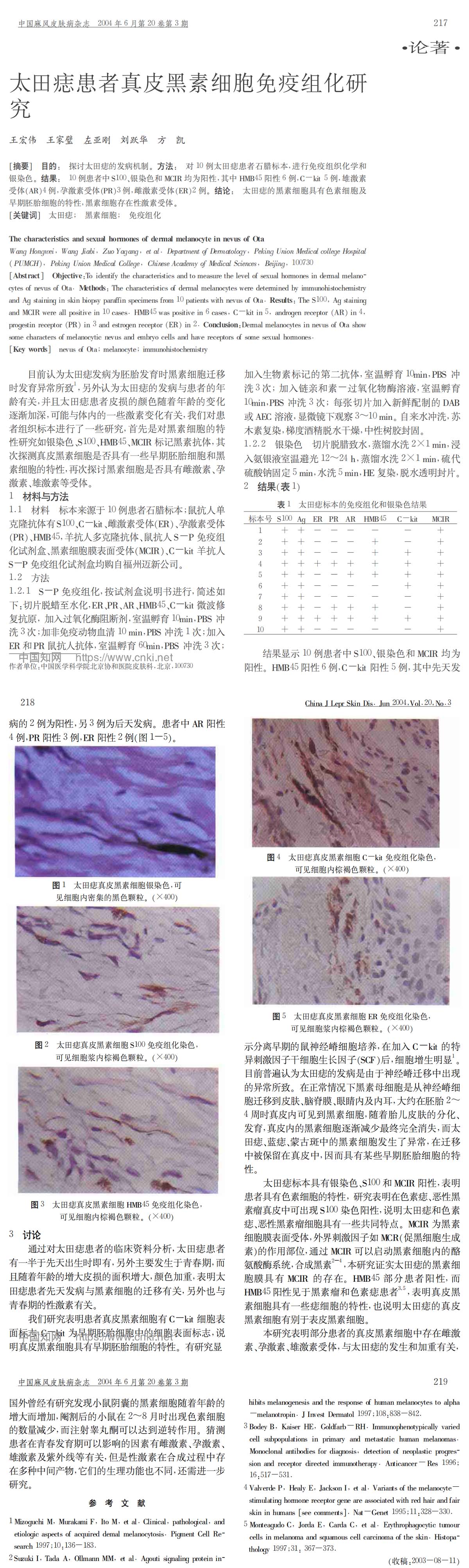 太田痣患者真皮黑素细胞免疫组化研究