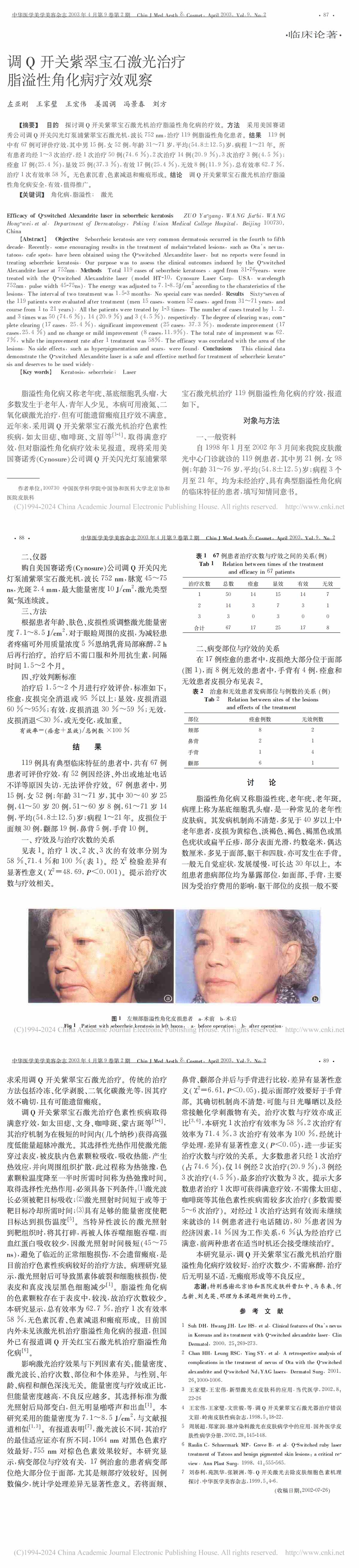 调 Q 开关紫翠宝石激光治疗脂溢性角化病疗效观察
