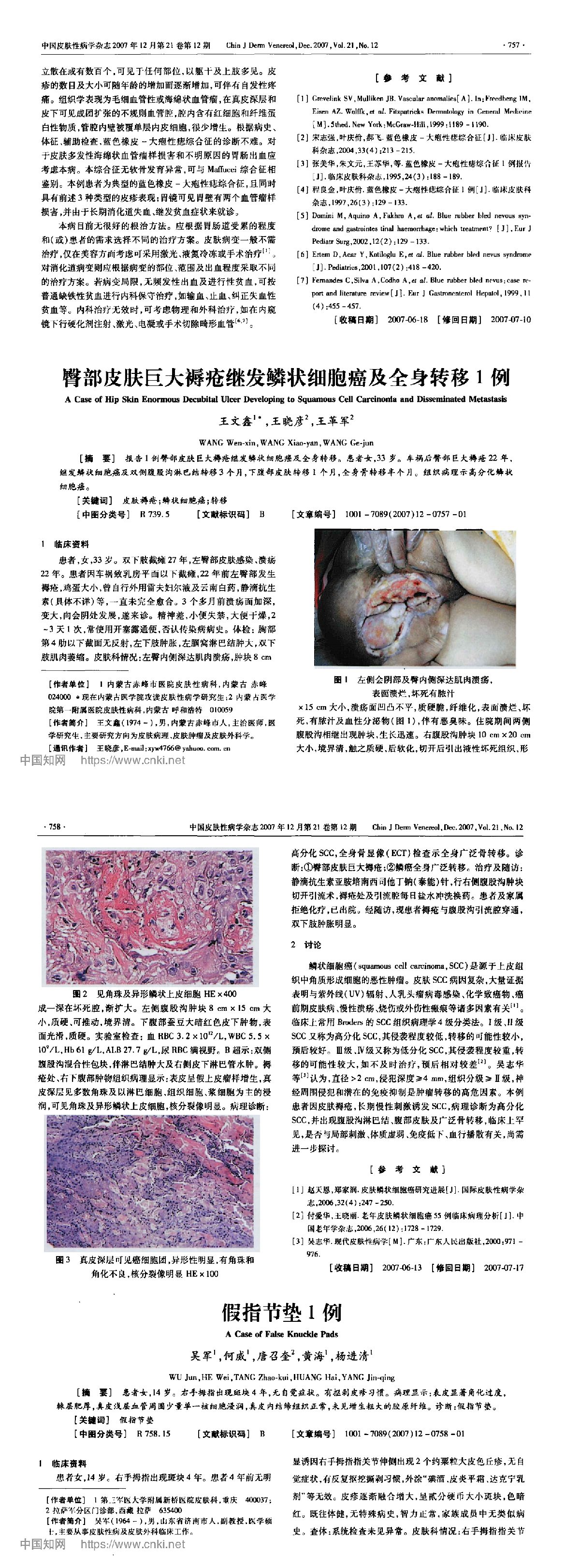 臀部皮肤巨大褥疮继发鳞状细胞癌及全身转移1例
