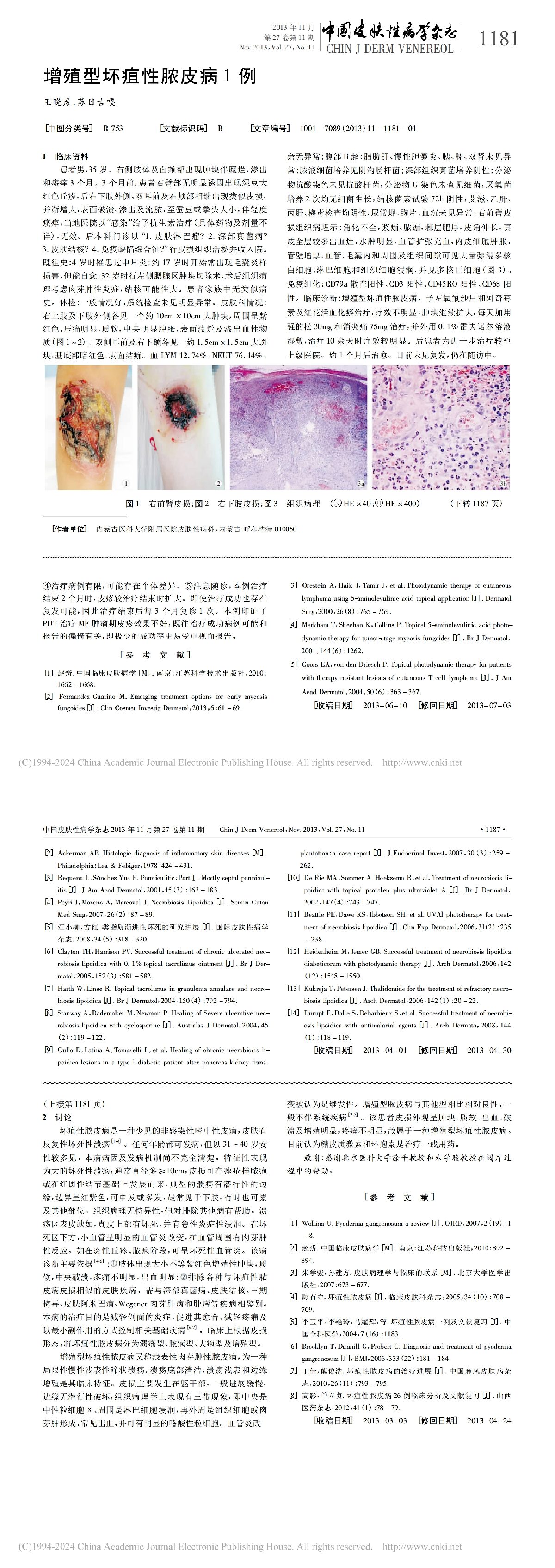 增殖型坏疽性脓皮病 1 例