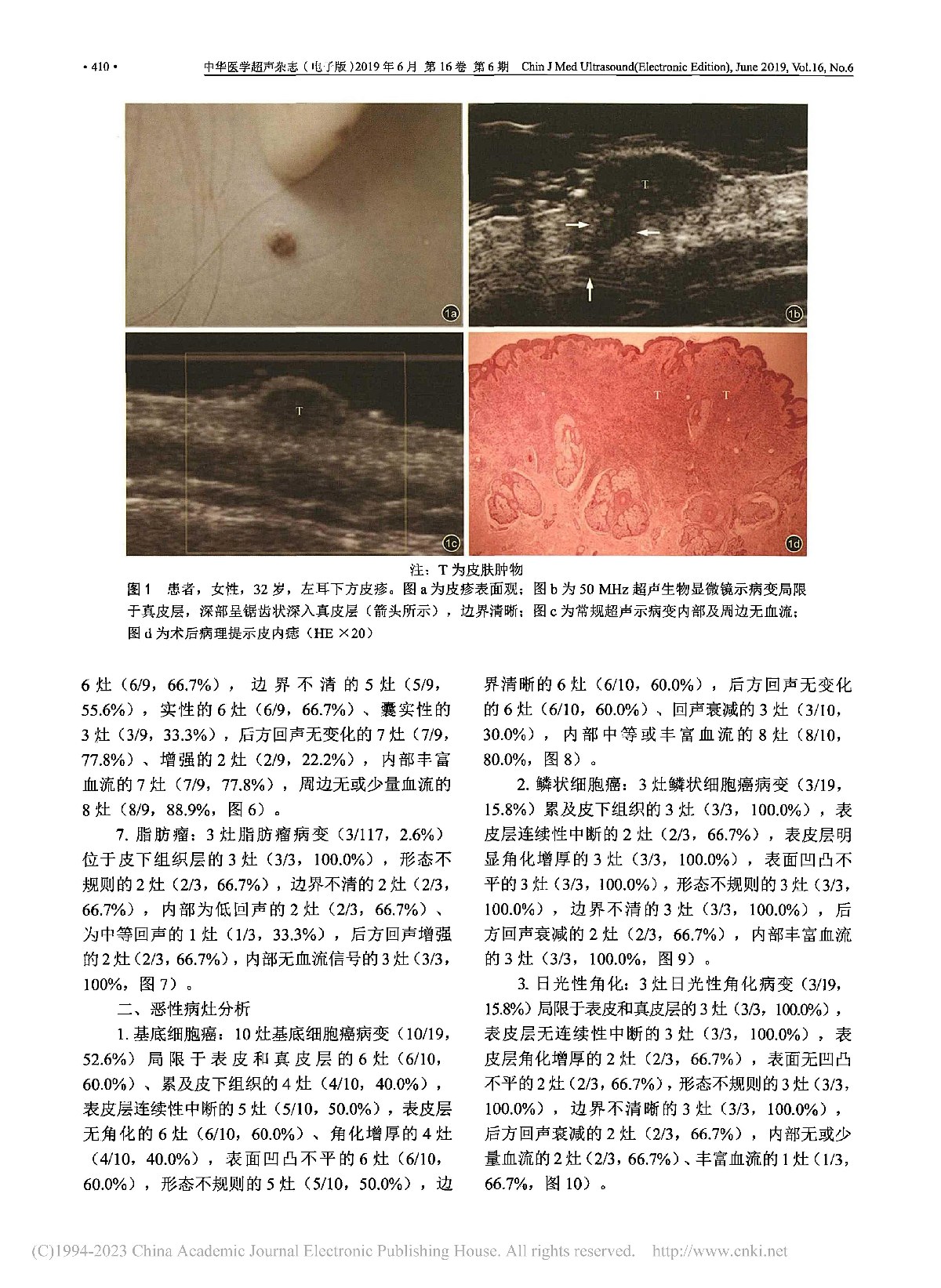 超声影像在皮肤病变诊断中的应用研究