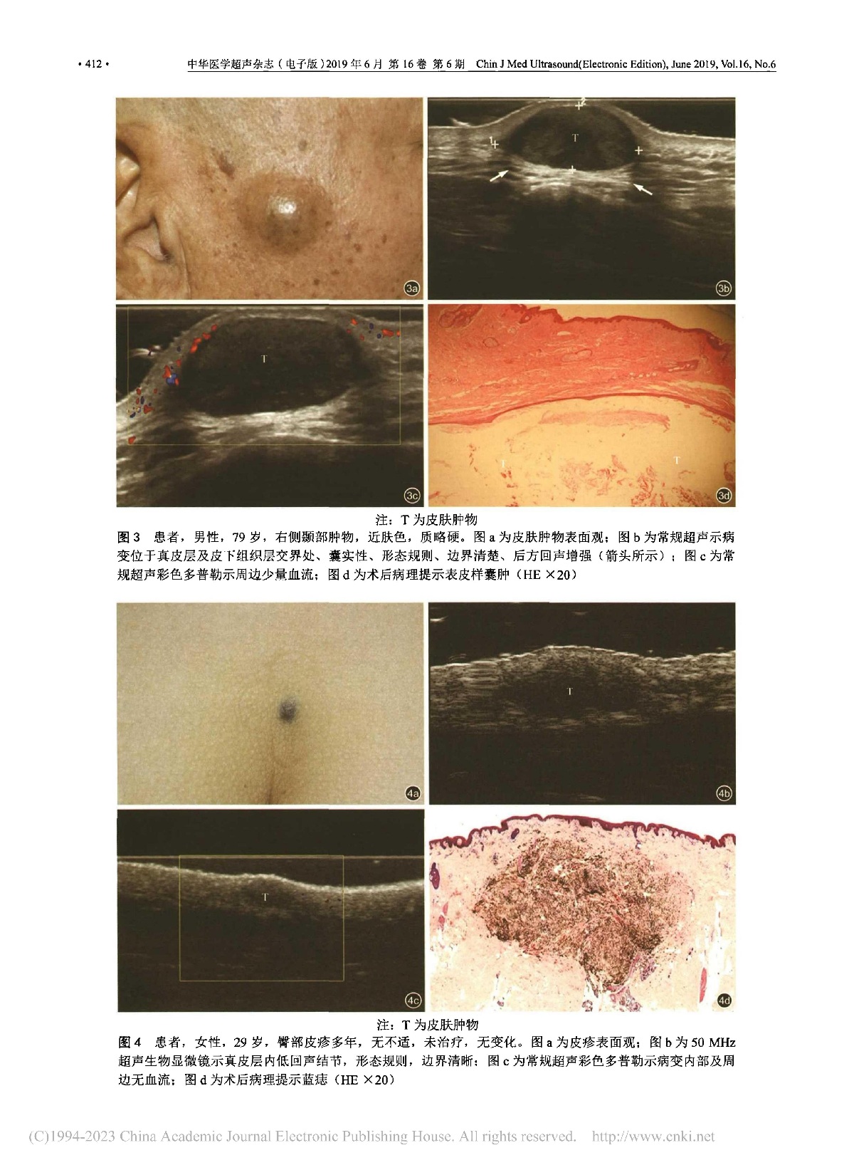 超声影像在皮肤病变诊断中的应用研究