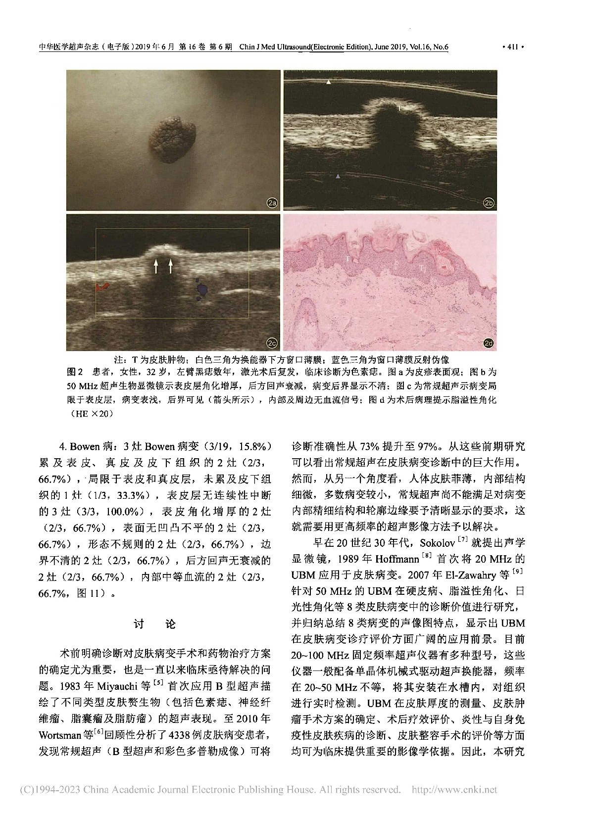 超声影像在皮肤病变诊断中的应用研究