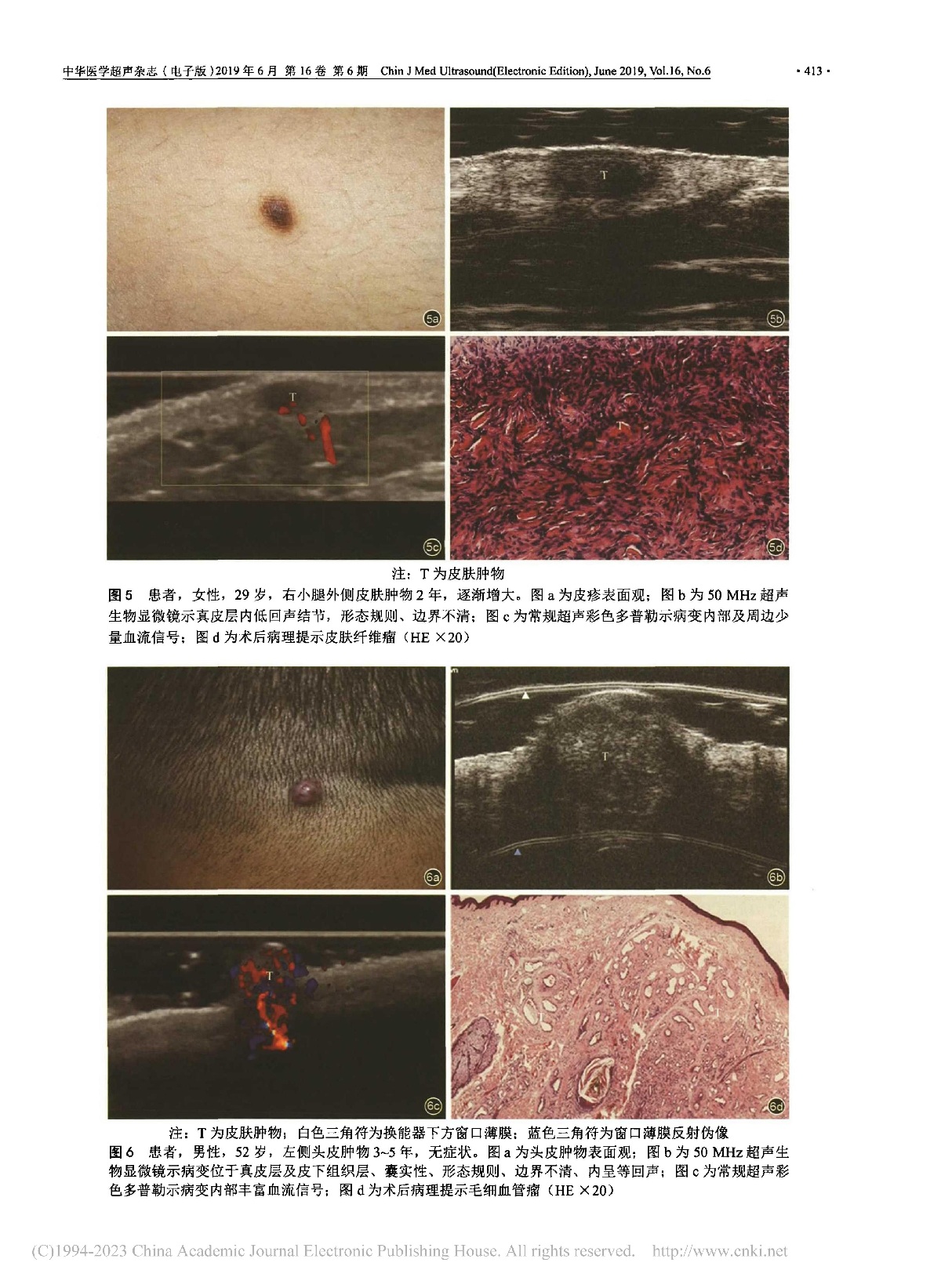 超声影像在皮肤病变诊断中的应用研究