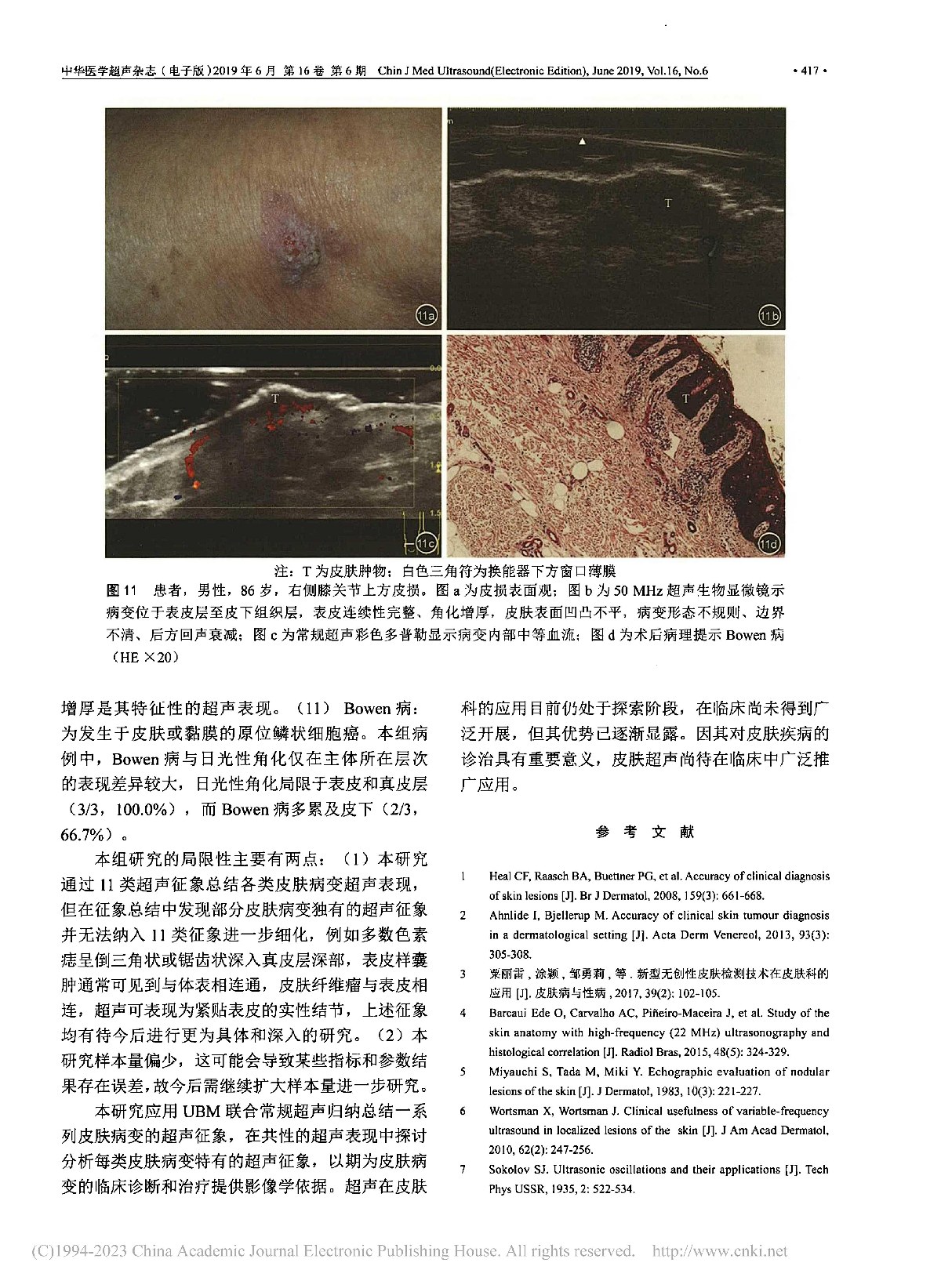 超声影像在皮肤病变诊断中的应用研究