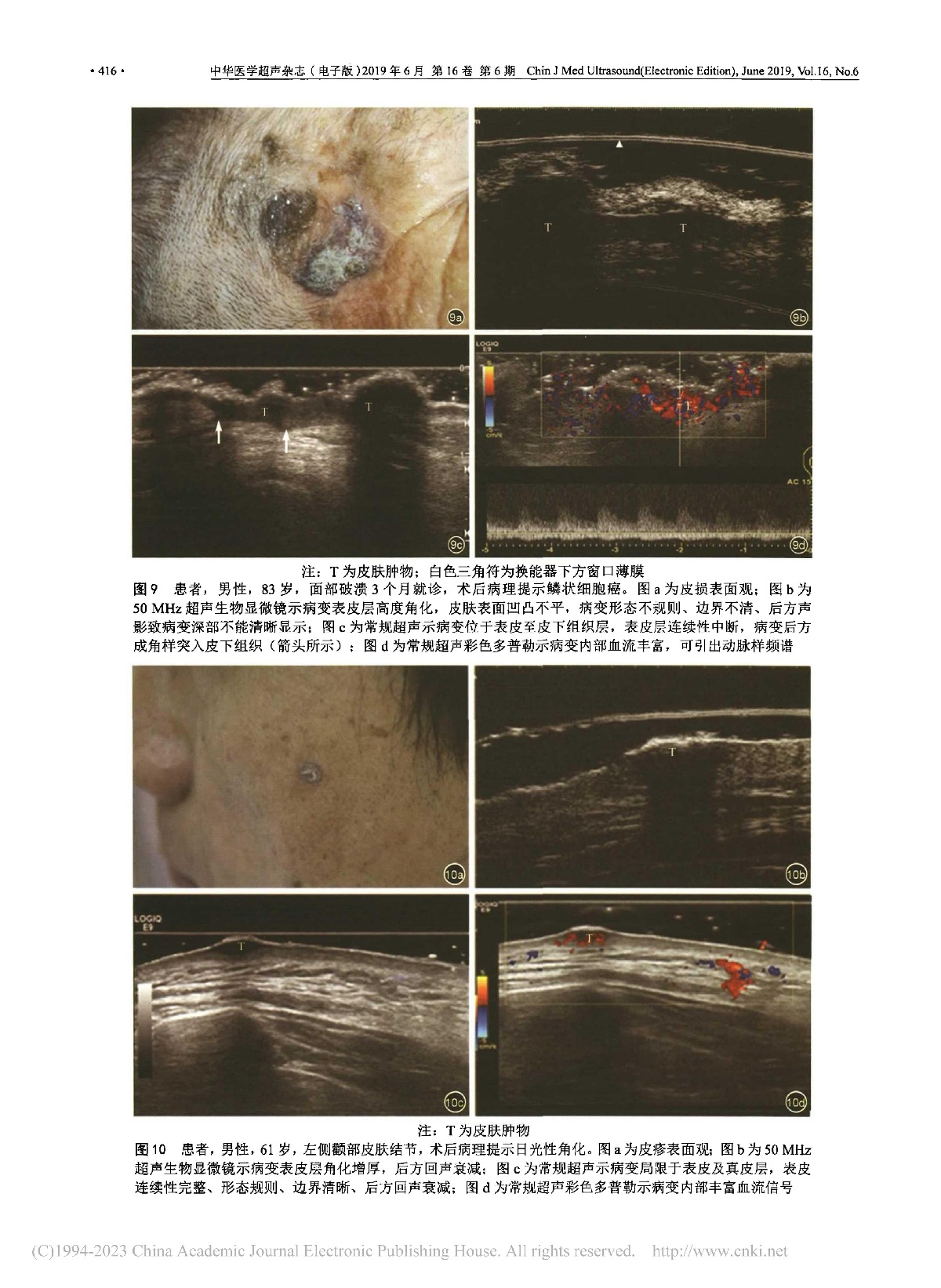 超声影像在皮肤病变诊断中的应用研究