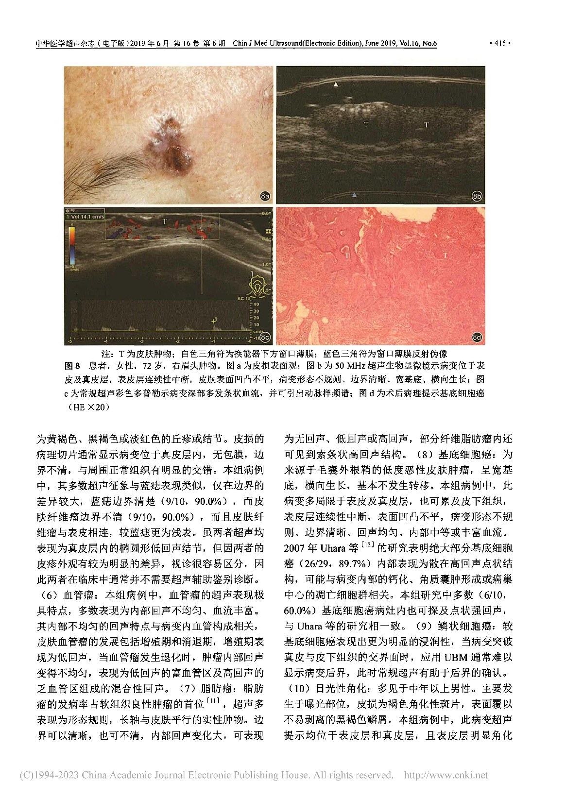超声影像在皮肤病变诊断中的应用研究