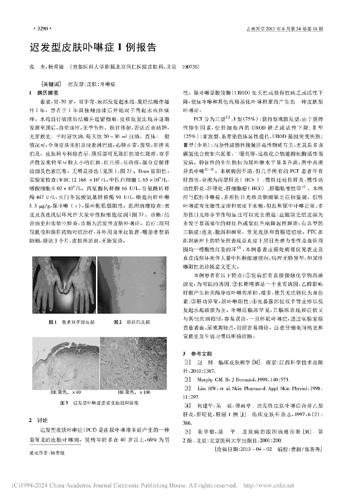 迟发型皮肤卟啉症 1 例报告