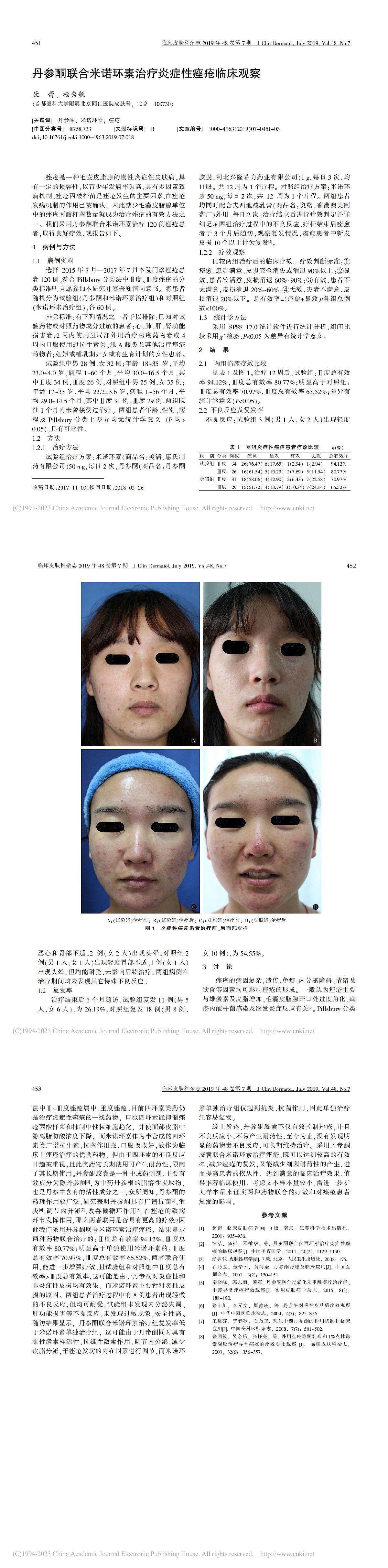 丹参酮联合米诺环素治疗炎症性痤疮临床观察