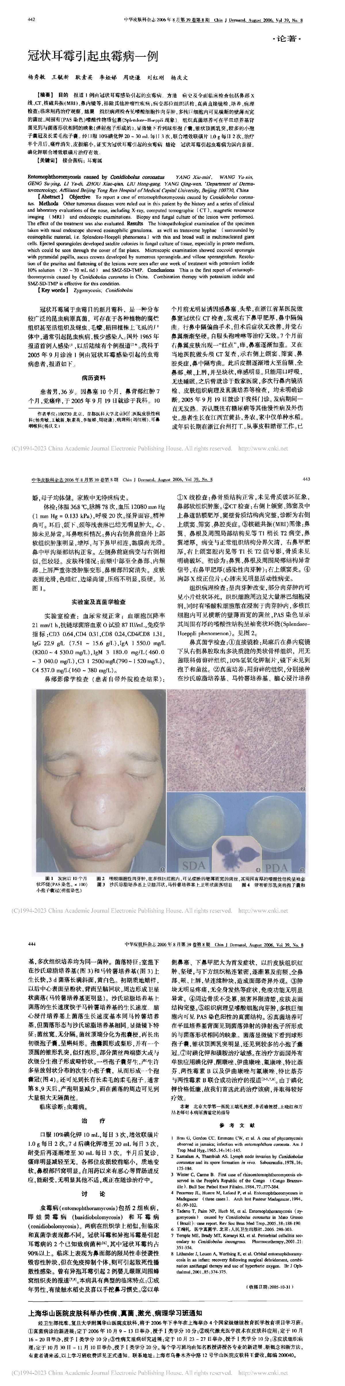 冠状耳霉引起虫霉病一例
