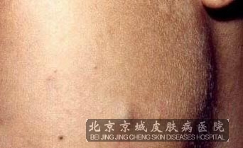 什么是多发性皮脂腺囊肿
