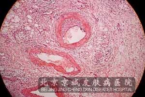 血管炎早期有哪些症状