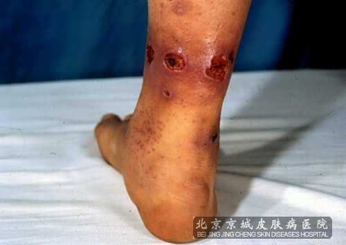 血管炎早期有哪些症状