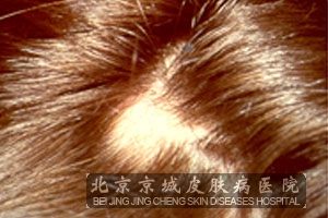 脂溢性脱发的症状