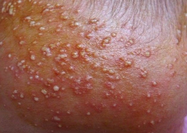 婴儿热痱子症状图片