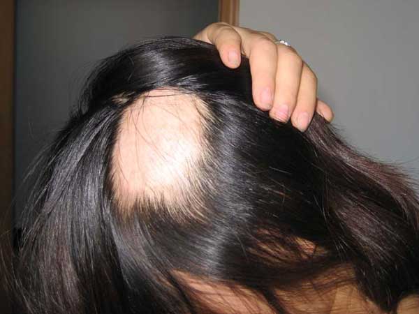 预防秃顶发生要做什么