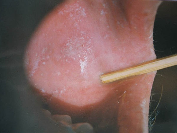 患口腔扁平苔藓会有哪些症状