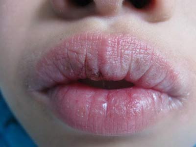 剥脱性唇炎发病会出现哪些症状