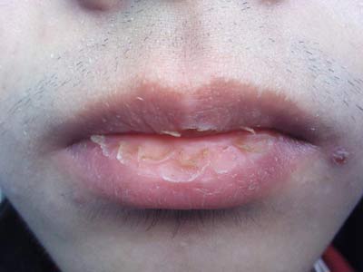 剥脱性唇炎具体症状是什么?