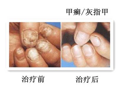 灰指甲怎么更好的治疗