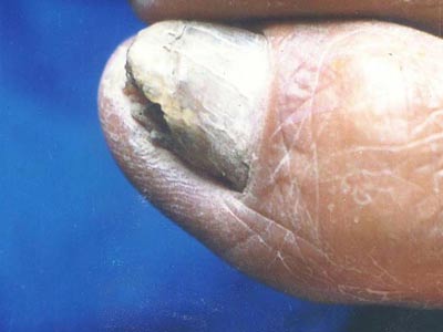 灰指甲具体的危害性有哪一些