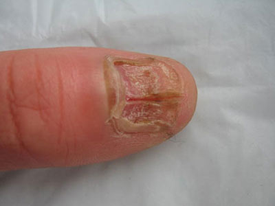 有灰指甲会造成什么危害
