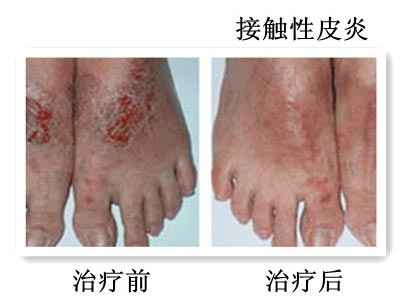接触性皮炎初期症状