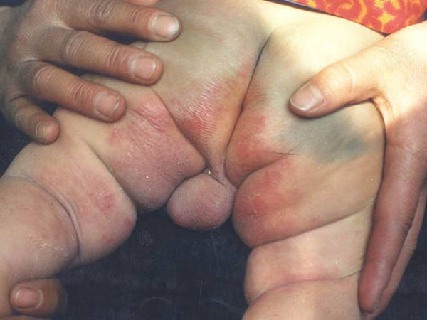 接触性皮炎出现的病因是什么