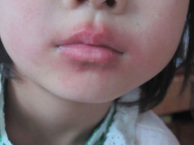 诱发口角唇炎的因素是哪些