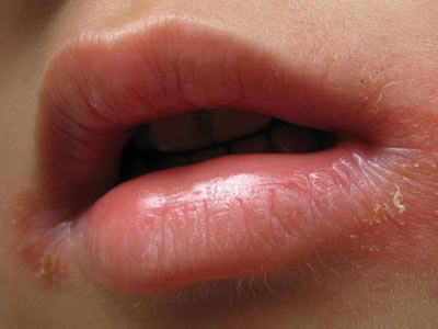 患口角唇炎有什么临床表现
