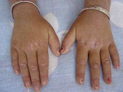 手出现皮肌炎的原因是什么呢