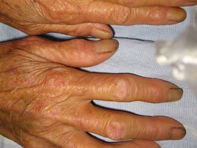 皮肌炎已经有些年头了有什么危害吗