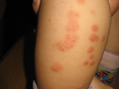 丘疹性荨麻疹是怎么发病的