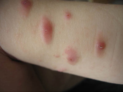 丘疹类荨麻疹的治疗方法之中医诊疗