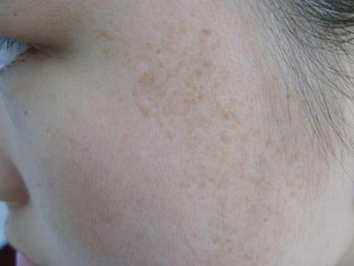 脸部色斑发生原因是什么?