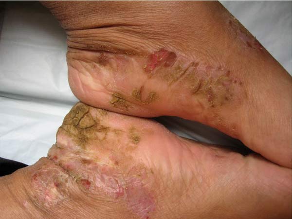 出现慢性湿疹多久能