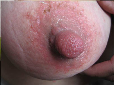 湿疹对女性的危害