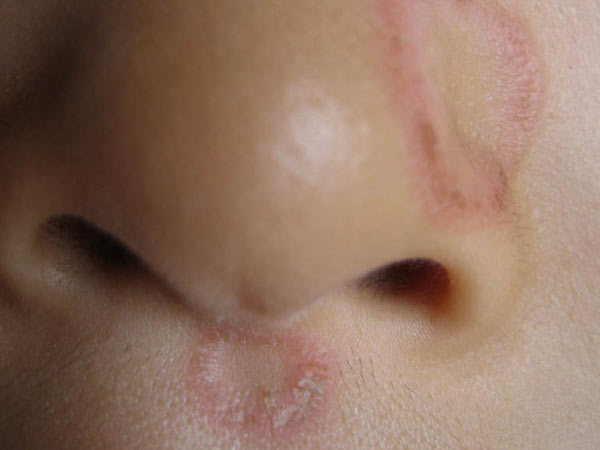 皮肤癣具体有哪些严重危害