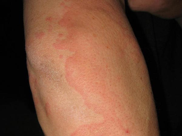 过敏性荨麻疹有传染性吗