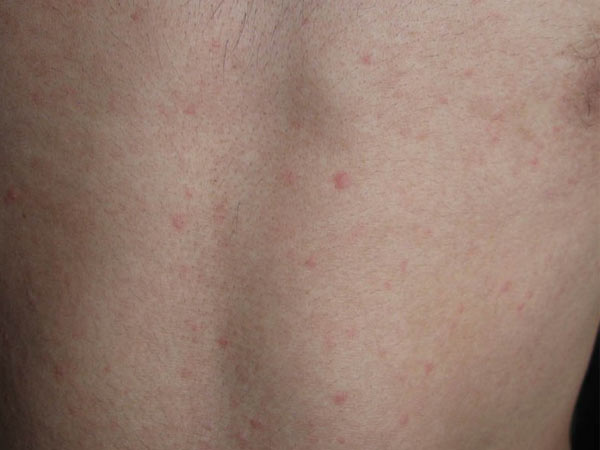 背部荨麻疹如何处理