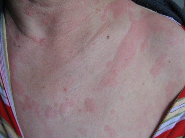 秋季易产生哪些类型的荨麻疹
