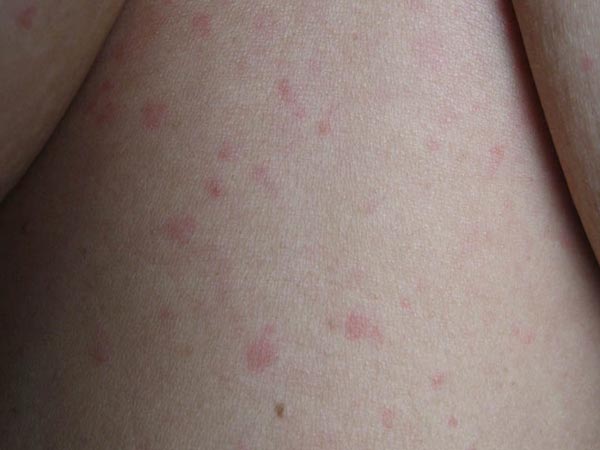 荨麻疹和红斑狼疮有什么区别