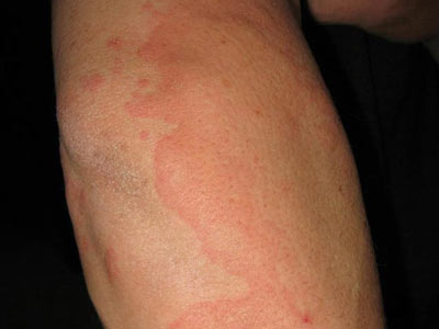 皮肤病荨麻疹的症状损伤有什么
