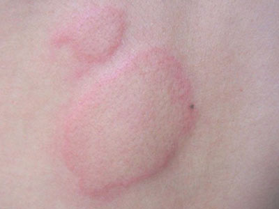 荨麻疹型皮肤病预防措施有什么