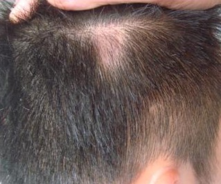 放松心情善待斑秃