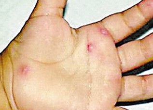 脓包疮是怎样发病的